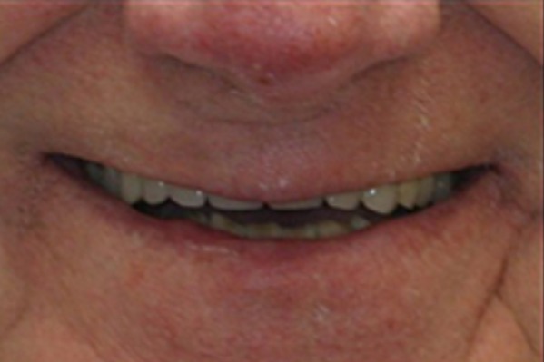 anterior-crowns-before