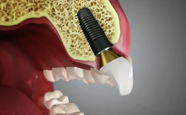 Can You Get Dental Implants in Cary if You Have Gum Disease?